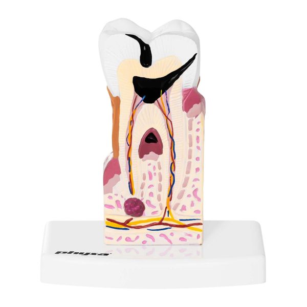 Хворий зуб - анатомічна модель