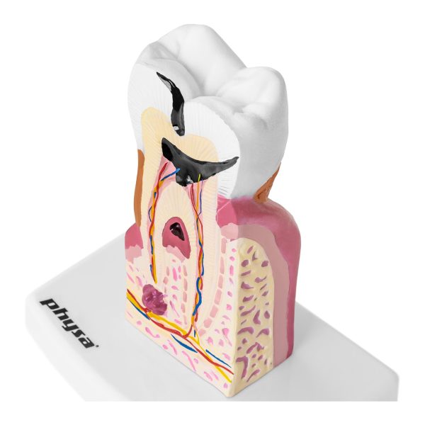 Хворий зуб - анатомічна модель