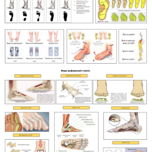 Плакат анатомії і деформації стопи